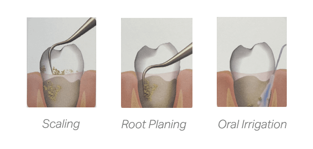 Three graphics showing the process of root planing