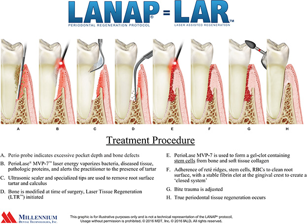 lanap gum disease treatment