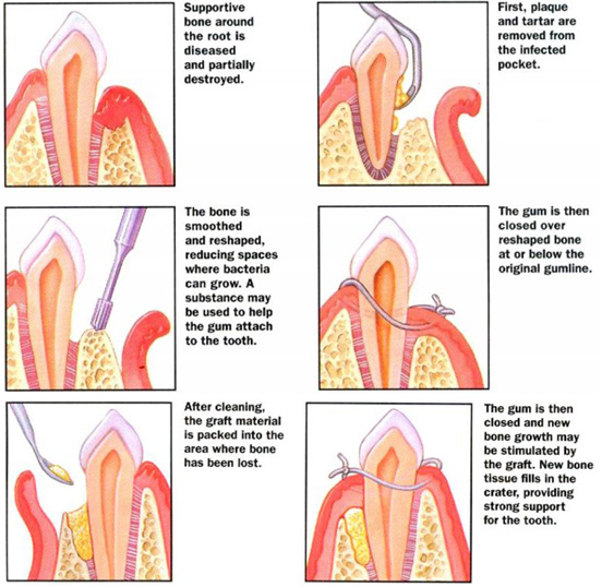 periodontal surgery huntington beach