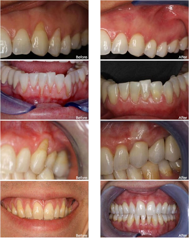 Six images of a patient before and after the Pinhole Surgical Rejuvenation procedure